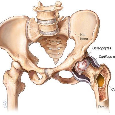 Болки в тазобедрената става