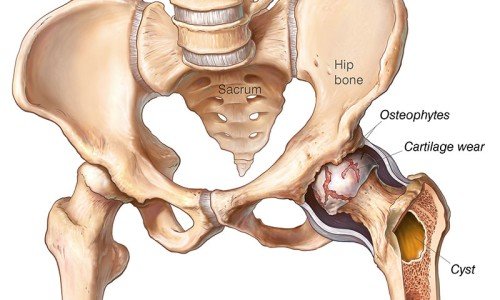 Болки в тазобедрената става