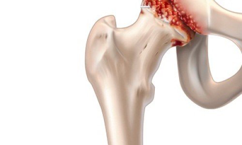 Болки в ставите и ставни болести – какво ги провокира?