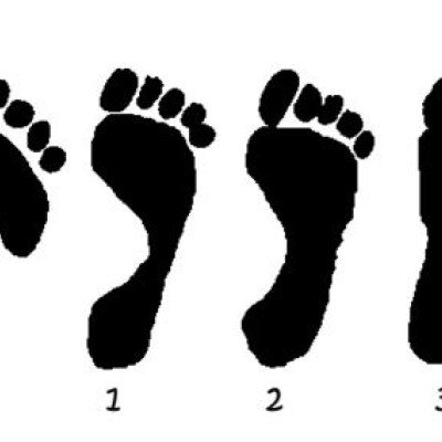 Какво причинява плоско стъпало и какво причинява плоското стъпало?