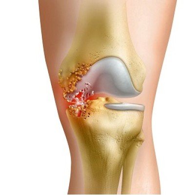 Артрит на коленната става – форми, видове, лечение