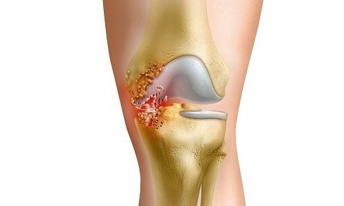 Артрит на коленната става – форми, видове, лечение