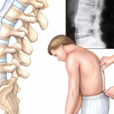 Болест на Бехтерев – симптоми, диагностика, лечение – част 1