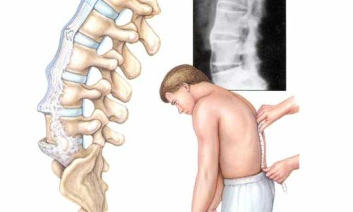 Болест на Бехтерев – симптоми, диагностика, лечение – част 1