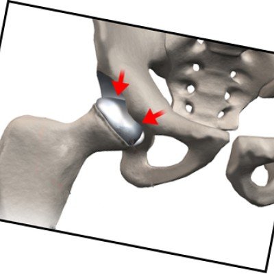 Болест на Пертес – всичко за причините и лечението и