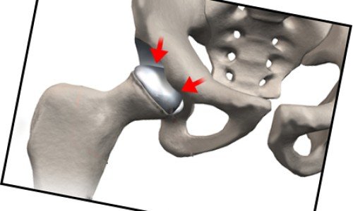 Болест на Пертес – всичко за причините и лечението и