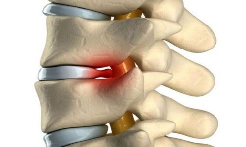 Дискова херния – част 1