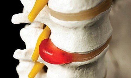 Дискова херния – част 2