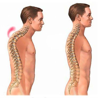 Кифоза – причините, симптомите, лечението