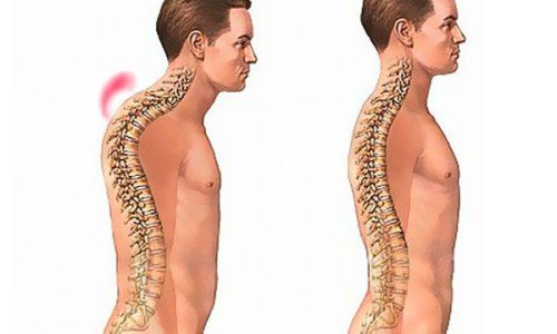 Кифоза – причините, симптомите, лечението
