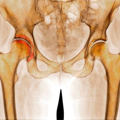 Коксартроза: всичко по темата – част 1