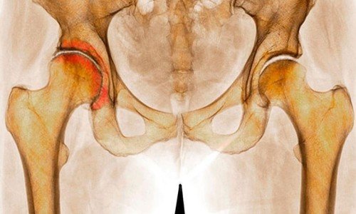 Коксартроза: всичко по темата – част 1