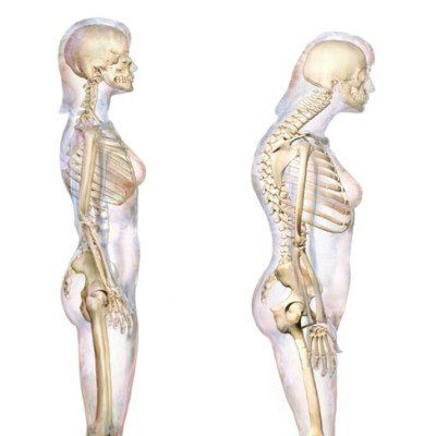 Лордоза – всичко по темата