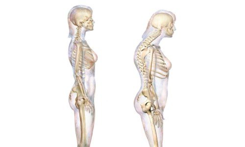 Лордоза – всичко по темата