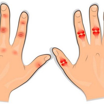От какво боледуват ставите на пръстите?