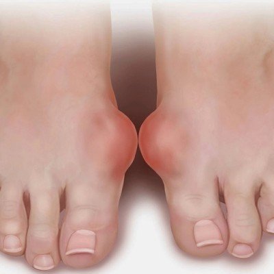 Подагра – диагностициране, лечение, диетичен режим – част 1