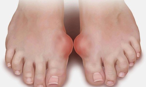 Подагра – диагностициране, лечение, диетичен режим – част 1