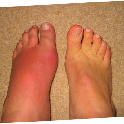 Подагра – диагностициране, лечение, диетичен режим – част 2