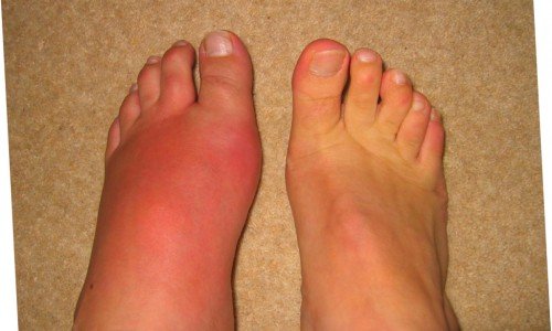 Подагра – диагностициране, лечение, диетичен режим – част 2