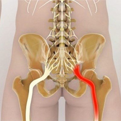 Прищипване на нерв в ставата: лечение, причини, профилактични мерки