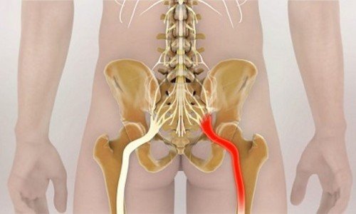 Прищипване на нерв в ставата: лечение, причини, профилактични мерки