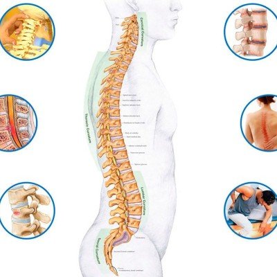 Радикулит – какво го провокира, как се лекува? – 1 част