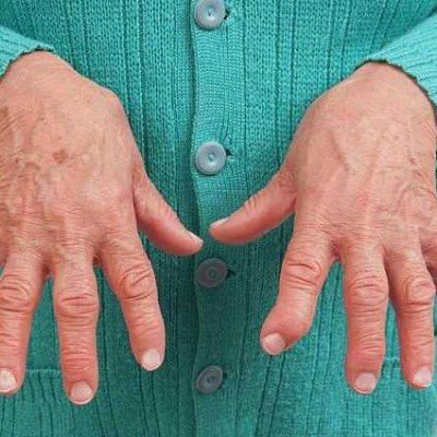 Ревматоиден артрит: всичко по темата – част 1