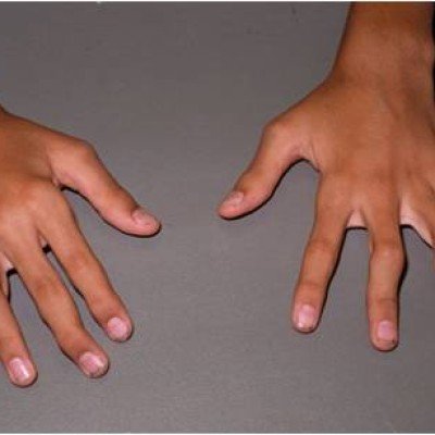 Ревматоиден артрит: всичко по темата – част 3