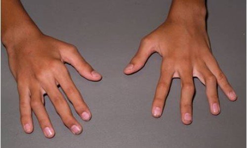 Ревматоиден артрит: всичко по темата – част 3