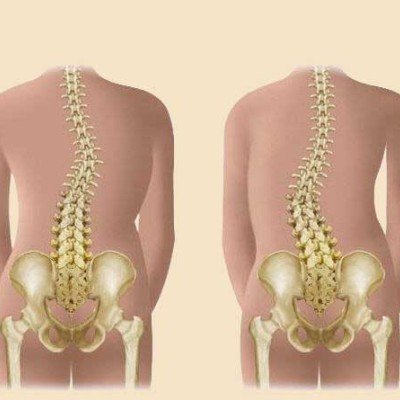 Сколиоза: какви са симптомите, лечението и профилактиката?