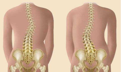 Сколиоза: какви са симптомите, лечението и профилактиката?