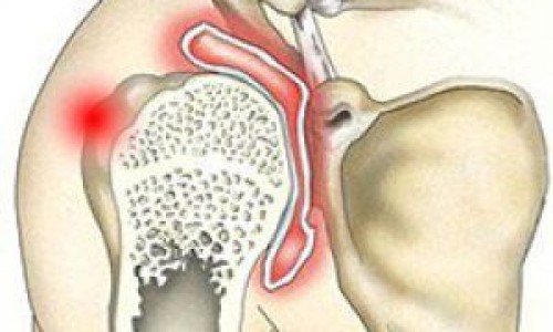 Артроза на раменната става – как се проявява и с какво се лекува?