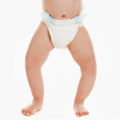 Болест на Блаунт – какви са причините, симптомите, лечението