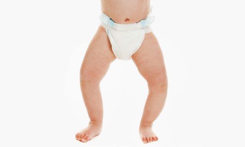 Болест на Блаунт – какви са причините, симптомите, лечението