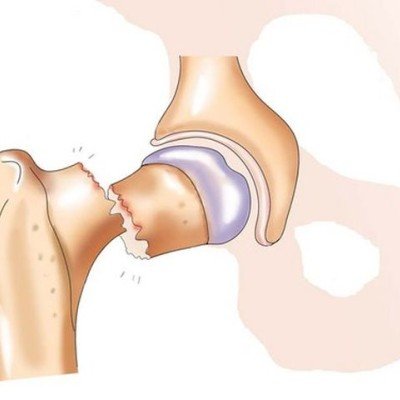 Фрактура на тазобедрената става – характеристика и съвременни методи за лечение – 1 част