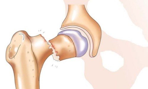 Фрактура на тазобедрената става – характеристика и съвременни методи за лечение – 1 част