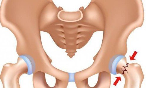 Фрактура на тазобедрената става – характеристика и съвременни методи за лечение – 2 част