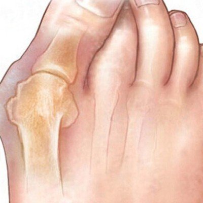 Hallux valgus – причини, симптоми, диагностика, лечение