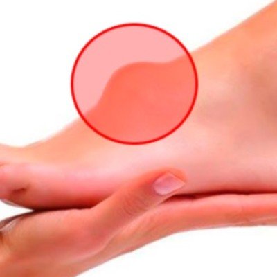 Хигрома на крака: видове, симптоми, лечение