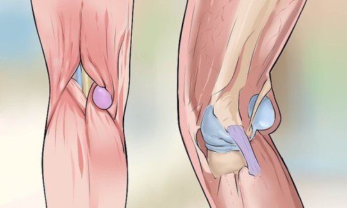 Киста на Бейкър – лечение и операция