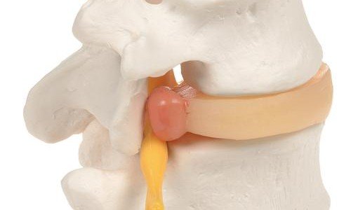 Може ли дисковата херния да се смали или да мине от само себе си?