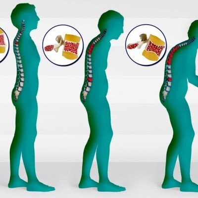 Остеопороза в периода на постменопауза: как да я предотвратим? – 1 част