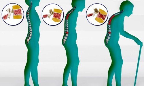Остеопороза в периода на постменопауза: как да я предотвратим? – 1 част