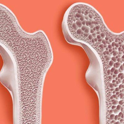 Остеопороза в периода на постменопауза: как да я предотвратим? – 2 част