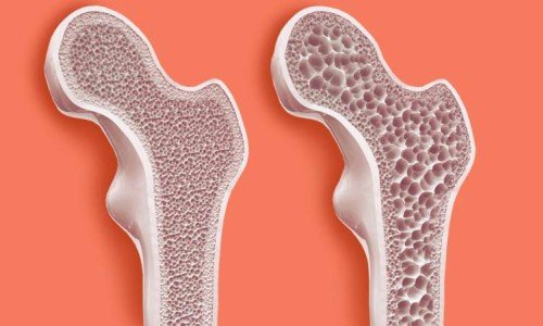 Остеопороза в периода на постменопауза: как да я предотвратим? – 2 част