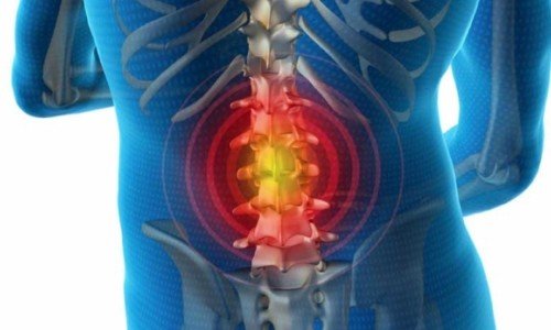 Правилно хранене при дискова херния – 2 част