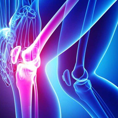 Сублуксация на коленната капачка