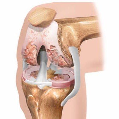 Причини за развитие и профилактика на артроза след 35-годишна възраст