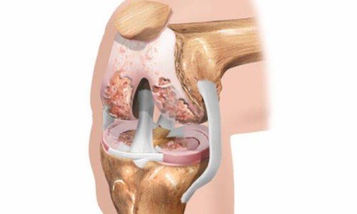 Причини за развитие и профилактика на артроза след 35-годишна възраст