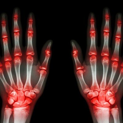 Продукти, които намаляват болката в ставите